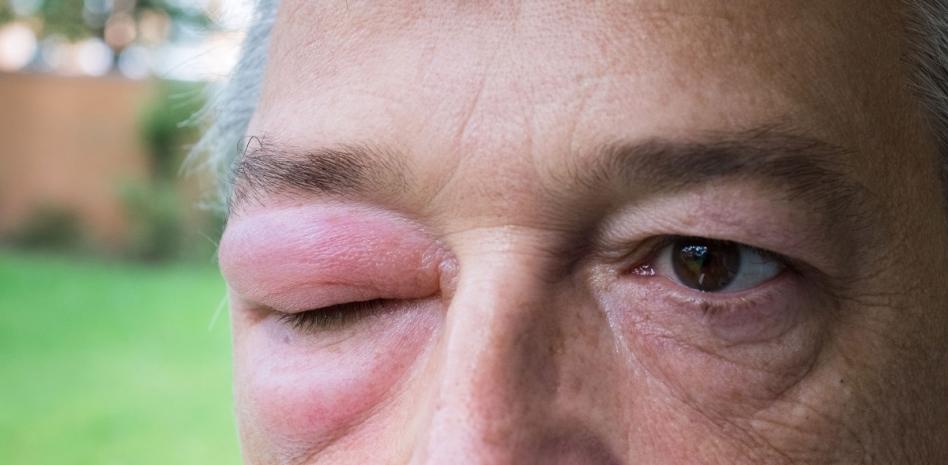 Angioedema hereditario, enfermedad que ocasiona hinchazones que pueden afectar la laringe y condicionar asfixia y muerte thumbnail