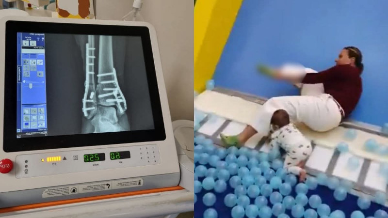 Accidente en área de juegos deja a mujer con severas lesiones en la Ciudad de México